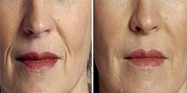 5 وصفات منزلية لإزالة التجاعيد والخطوط الرفيعة