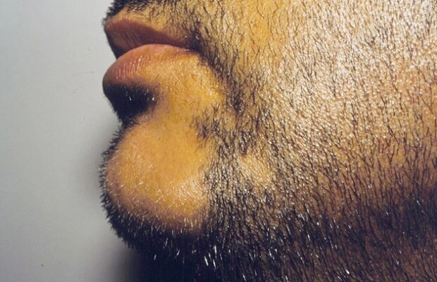 beard alopecia areata
