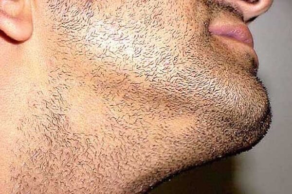 beard alopecia areata