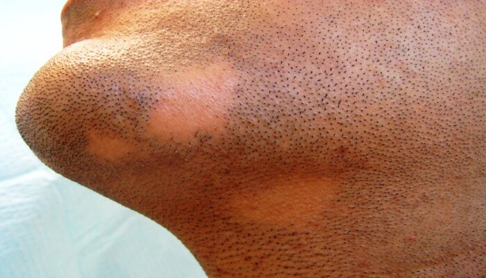 ثعلبة الذقن