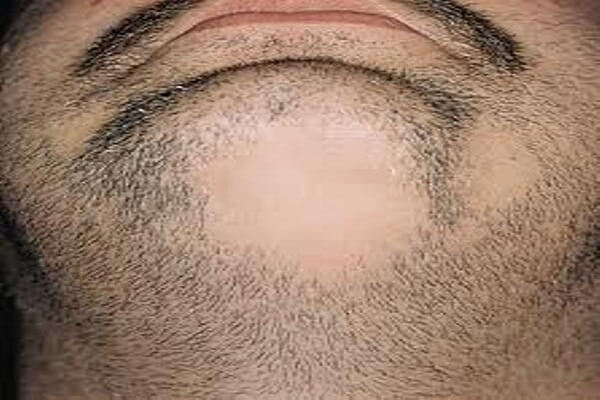 ثعلبة الذقن