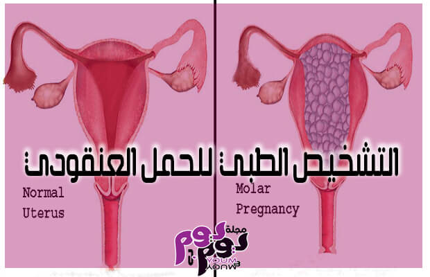 التشخيص الطبي للحمل العنقودي