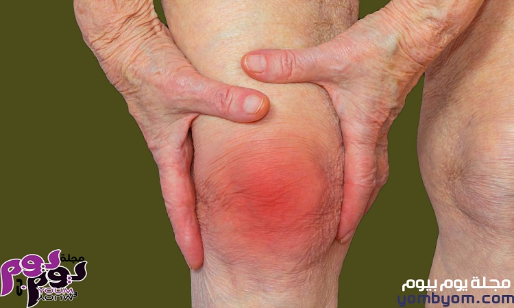 الفرق بين الروماتيزم والروماتويد