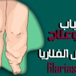 مرض الفلاريا
