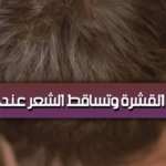علاج القشرة وتساقط الشعر عند الرجال