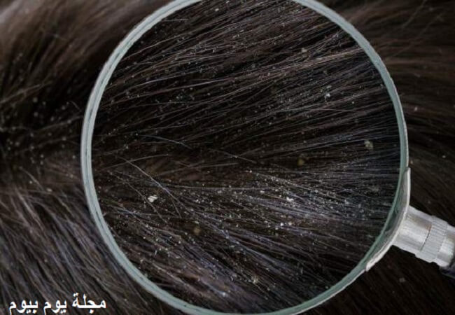 علاج القشرة وتساقط الشعر عند الرجال