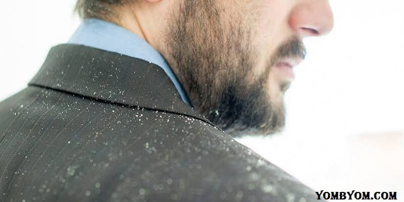 علاج القشرة وتساقط الشعر عند الرجال