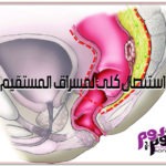 استئصال كلي لمسراق المستقيم