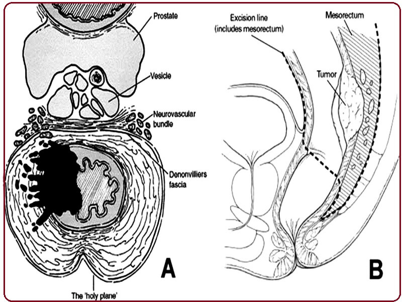 استئصال كلي لمسراق المستقيم