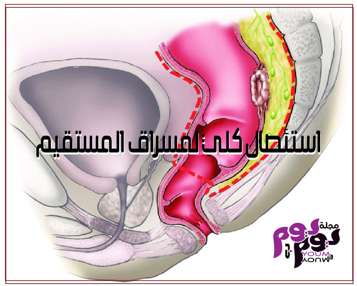 استئصال كلي لمسراق المستقيم