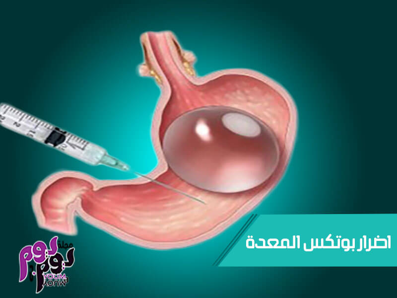 بوتكس المعدة