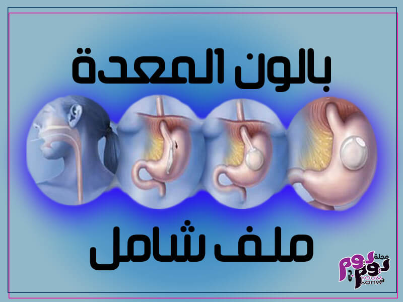 بالون المعدة - Intragastric balloon