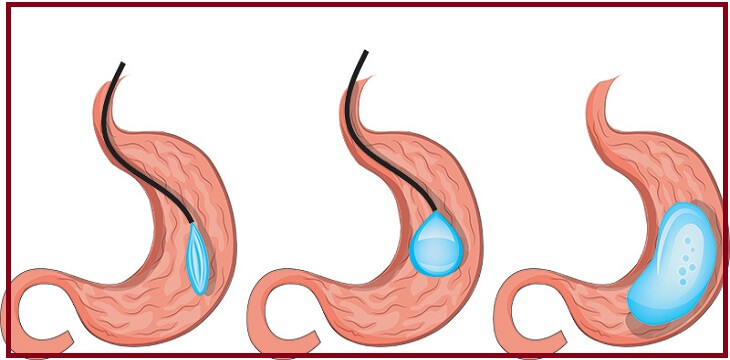 بالون المعدة - Intragastric balloon