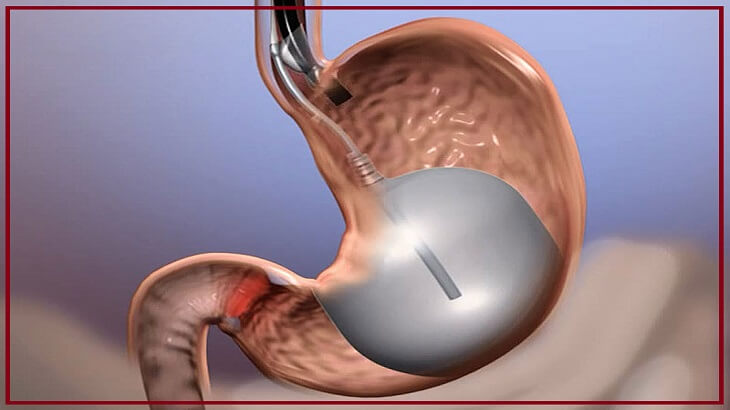 بالون المعدة - Intragastric balloon