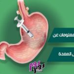 بوتكس المعدة
