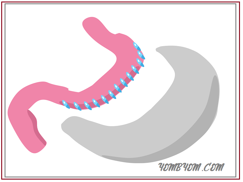 تكميم المعدة