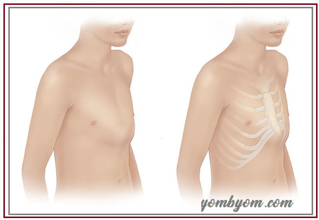 جراحة تشوهات الصدر