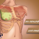 جراحة تشوهات الصدر