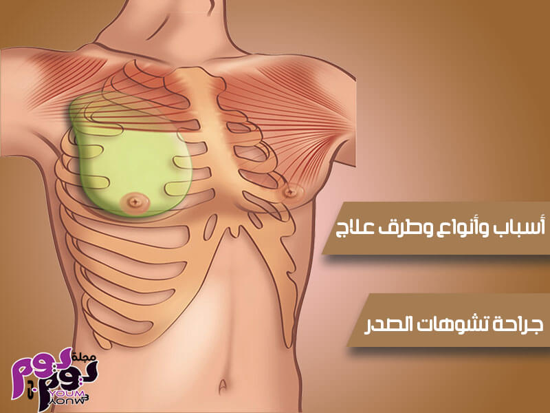 جراحة تشوهات الصدر