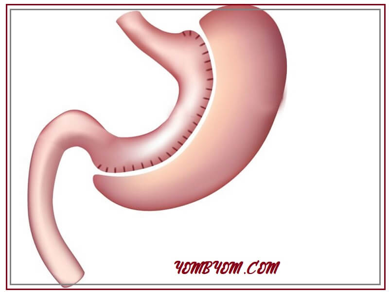 جراحة تكميم المعدة