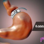 ربط المعدة Gastric banding