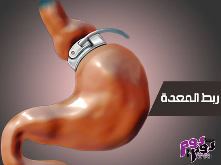 ربط المعدة Gastric banding