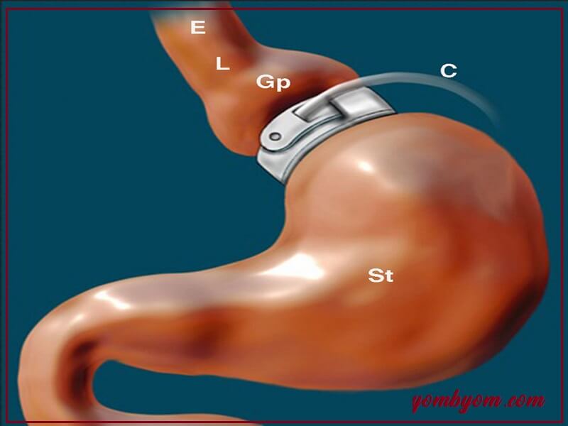 Gastric banding