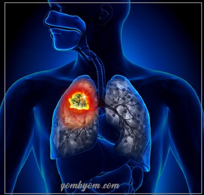 سرطان غشاء الجنب