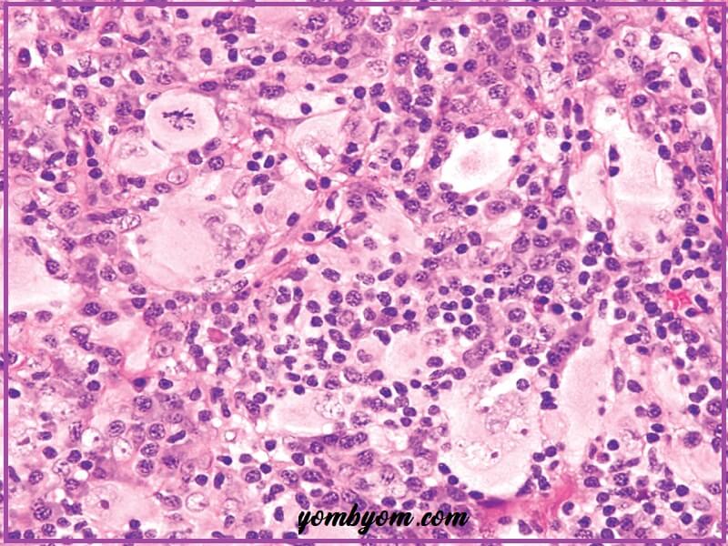 سرطان غشاء الجنب