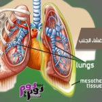 سرطان غشاء الجنب