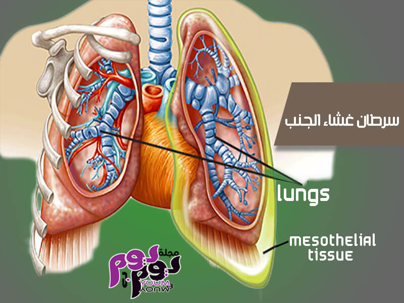 سرطان غشاء الجنب