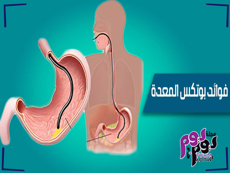 بوتكس المعدة