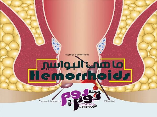 البواسير Hemorrhoids الأسباب والأعراض والتشخيص وكيفية العلاج مجلة يوم بيوم