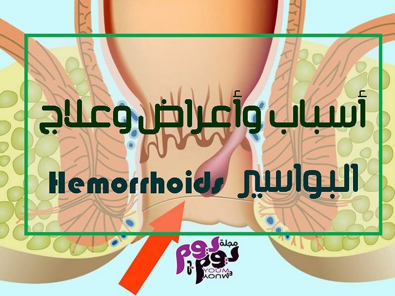 البواسير Hemorrhoids