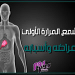 تشمع المرارة الأولي