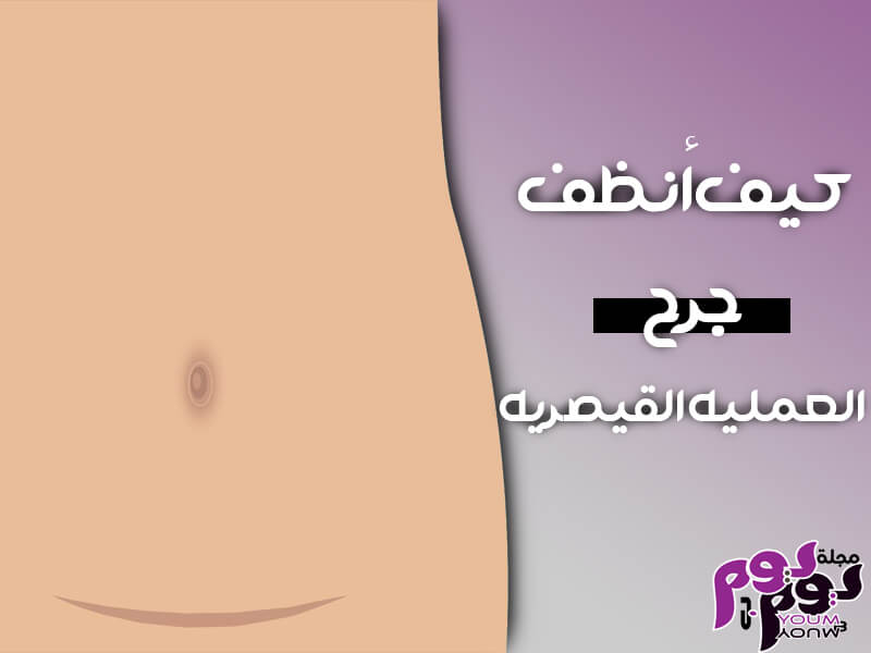 تصلب جرح العملية القيصرية