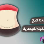 تصلب جرح العملية القيصرية